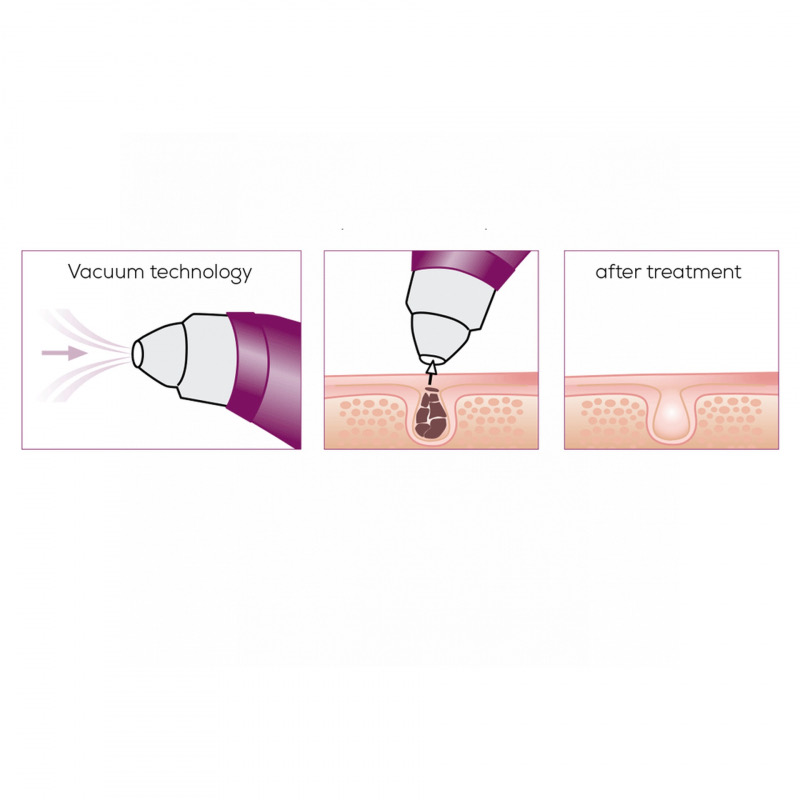 BEURER FC 40 Vákuový prístroj na hĺbkové čistenie pórov